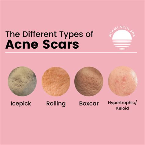 5 Types of Acne Scars and How to Treat Them